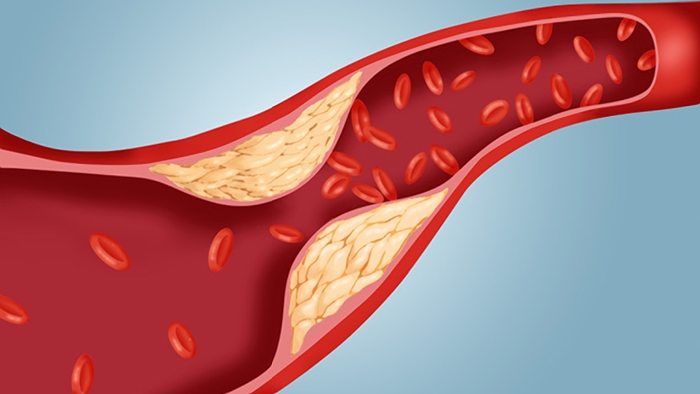 Cholesterol will clog your arteries?